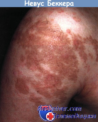 Nevus Becker - diagnostic, tratament