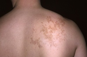 Nevus Becker - Cauze, simptome, diagnostic, tratament, fotografie