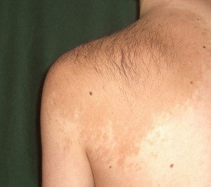 Nevus Becker - Cauze, simptome, diagnostic, tratament, fotografie