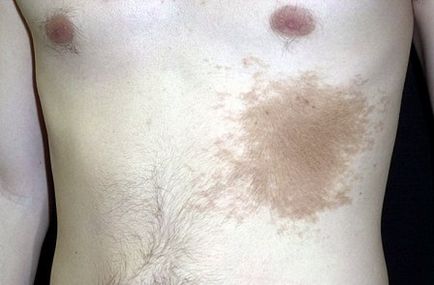 Nevus Becker Simptome, caracteristici distinctive, diagnostic, metode de tratament