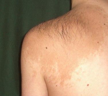 Nevus Becker Simptome, caracteristici distinctive, diagnostic, metode de tratament