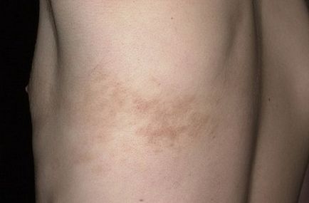 Nevus Becker Simptome, caracteristici distinctive, diagnostic, metode de tratament