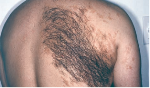 Nevus de becker (păr) cauze, tratament, fotografie