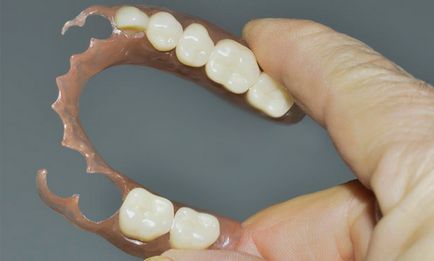 Нейлоновий зубний протез що це таке, ціни в казань фото, відгуки пацієнтів про протезуванні