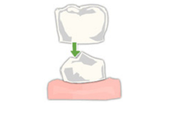 Облицювання зубів під коронки навіщо потрібна і як проводиться