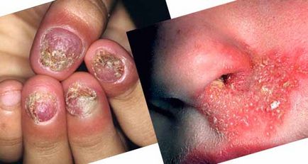 Riscul de infectare este periculos pentru manichiura, zarianisenia