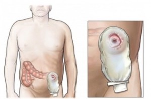 Operații privind indicațiile și tipurile intestinului