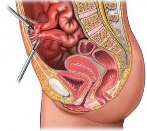 Операції на кишечнику показання і види
