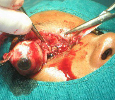 Műtéti eltávolítása a szem jelzések, technikák, klinikák, árak