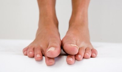 Опухла кісточка на нозі що робити, ніж лікувати пухлина кісточки великого пальця ноги