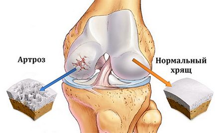 Umfla genunchi fără vânătăi și doare la care medic să se ocupe, tratament, cum să eliminați puffiness