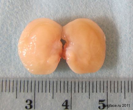 Tumor Abrikosova (mioblastomioma)