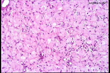 Cancer de țesut (mioblastomiom)