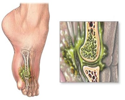 Osteomielita, simptomele și tratamentul bolii sunt complicate de gradul de inflamație