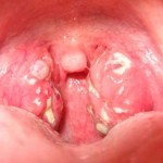 Simptome amigdoase acute și tratamentul durerii acute în gât