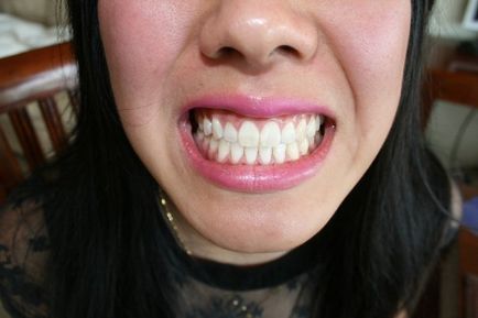 Albirea dinților acasă 5 cele mai bune căi