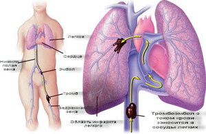 Edem pulmonar, tipurile de edem pulmonar al unui adult, cauzele și consecințele acestei boli și