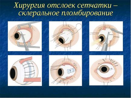 Відшарування і дегенерація сітківки ока