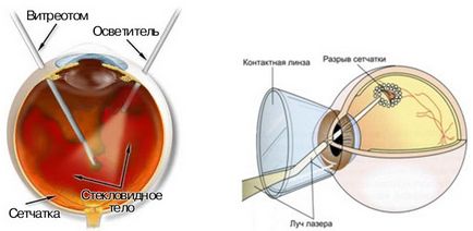 Leválása és retina degeneráció