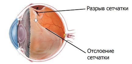 Відшарування і дегенерація сітківки ока