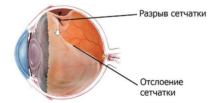 Leválása és a retina degenerációja (szem) Leválása és retina degeneráció