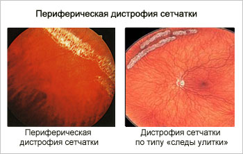 Відшарування і дегенерація сітківки ока