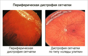 Leválása és retina degeneráció