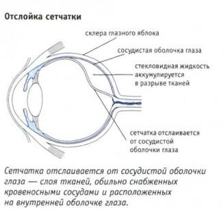 Detoxifierea retinei provoacă, simptome, ce este, tratament cu remedii folclorice,