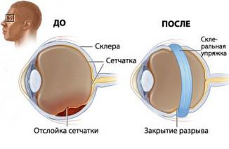 Detoxifierea retinei provoacă, simptome, ce este, tratament cu remedii folclorice,