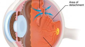 Відшарування сітківки ока причини, симптоми, що це таке, лікування народними засобами,