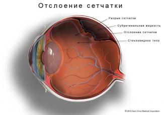 Відшарування сітківки ока причини, симптоми, що це таке, лікування народними засобами,