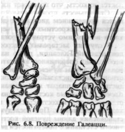 Fracturile ulnei, însoțite de o dislocare a capului razei - traumatologie și