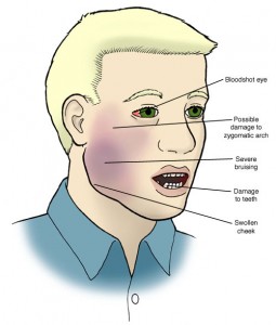 Fractura simptomelor maxilarului inferior și superior, caracteristicile tratamentului și alimentației în fractura maxilarului