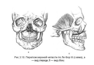 Fractura simptomelor maxilarului inferior și superior, caracteristicile tratamentului și alimentației în fractura maxilarului