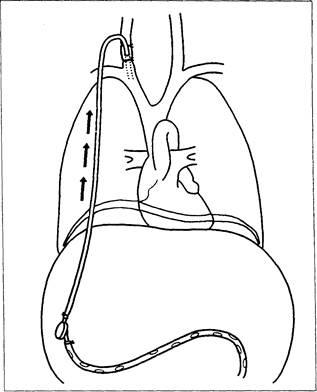 Șuntul peritonevenos (șunt levina) - stadopedia 1