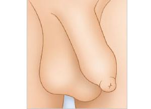P - phimosis (phimosis) P - phimosis