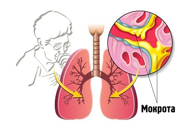 Погано відходить мокротиння при кашлі у дорослого і дитини що робити