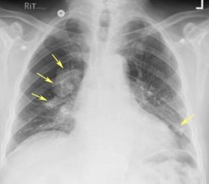 Tipuri de pneumoconioză, simptome, tratament - secrete de sănătate