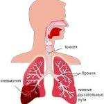 Пневмонія при цукровому діабеті рідина в легенях і набряки, причини і лікування захворювання