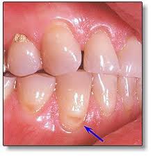 Покриття зубів фторлаком - ефективний засіб боротьби з карієсом