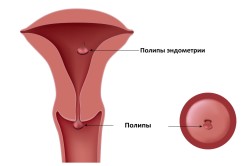 Polip a nyelőcső tünetek és kezelés