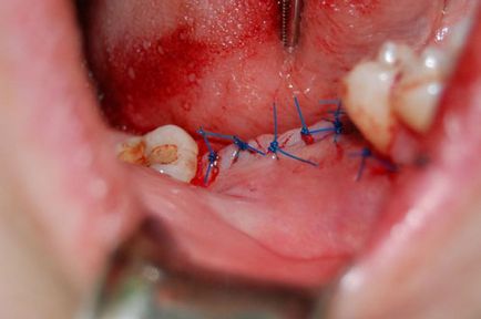 Miután eltávolítottuk a fogfájás szomszédos fogak ez miért történik
