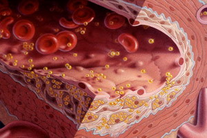 Потенційна проблема при атеросклерозі ниркових артерій лікування, симптоми