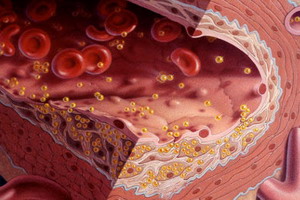 Problema potențială cu tratamentul aterosclerozei arteriosclerozei, simptome