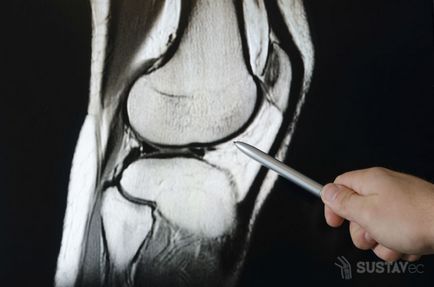 Deteriorarea cornului posterior al rupturii orizontale a meniscului medial al corpului meniscului interior 3