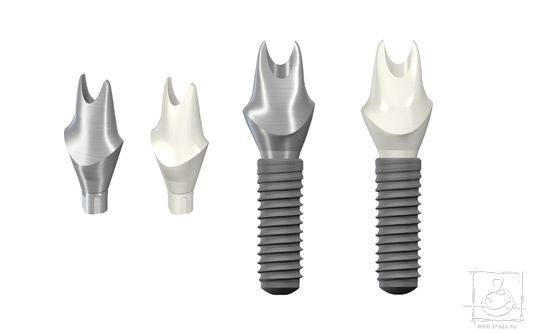 A helyes választás az ütköző a fogászati ​​implantátum