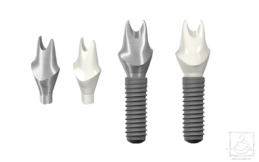 Правилният избор на надстройката на зъбни импланти