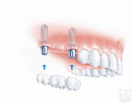 Alegerea corectă a opririi în implantarea dentară