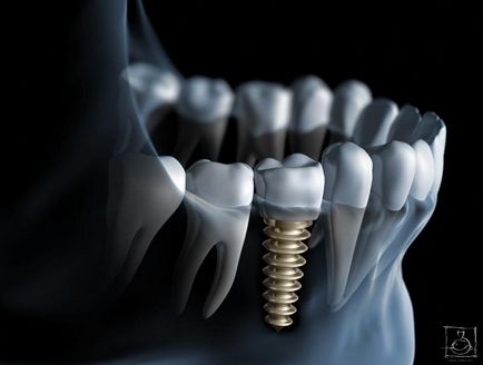 Alegerea corectă a opririi în implantarea dentară