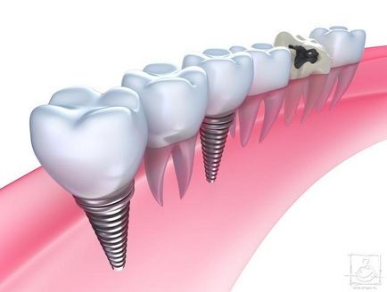 Alegerea corectă a opririi în implantarea dentară